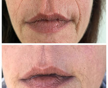 Load image into Gallery viewer, Mouth Wrinkle Smoothing Masks