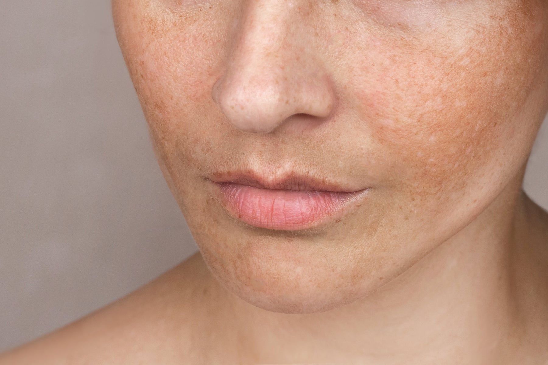 Pigmentation & Dark Spots