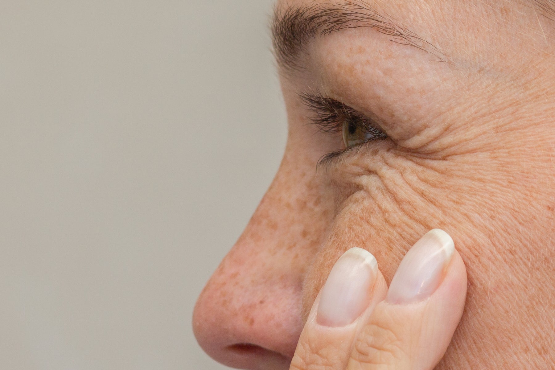 Under-Eye Concerns